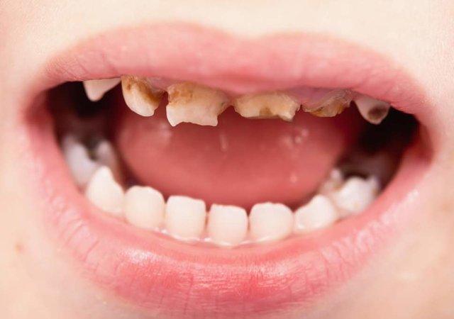 خراب بودن دندان های شیری ممکن است به سوء تغذیه منجر گردد