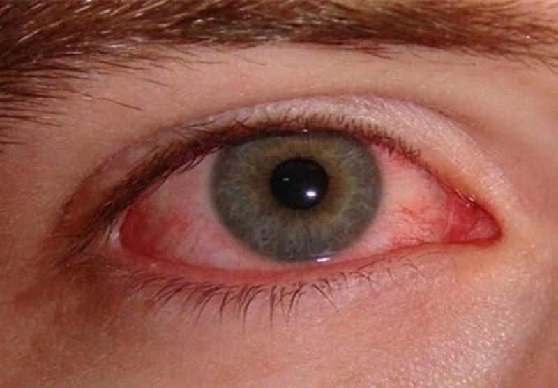 راهکارهایی برای مراقبت از چشم در برابر ویروس کرونا