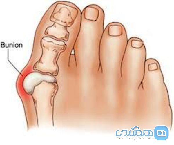 شست کج چه زمانی برای اصلاح به جراحی نیاز ندارد؟ شست کج چه زمانی برای اصلاح به جراحی احتیاج ندارد؟