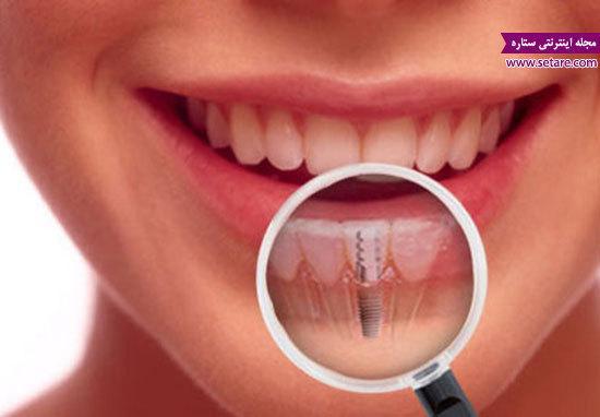 مراحل ایمپلنت دندان (کاشت دندان) چگونه است؟!