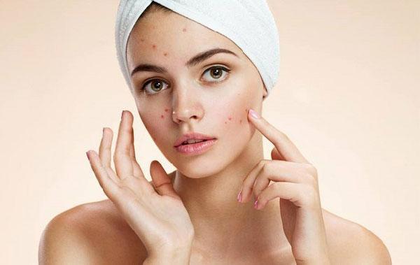 محلول کلیندامایسین موثر در درمان جوش صورت