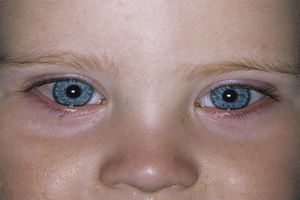 علت قرمزی چشم نوزاد چیست؟ (راه های درمان)