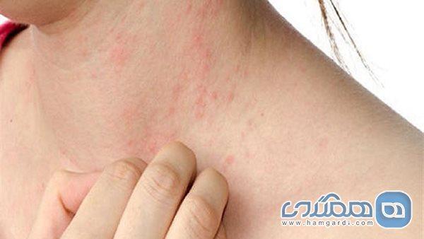 شایع ترین مسائل پوستی در تابستان و راههای جلوگیری از آنها