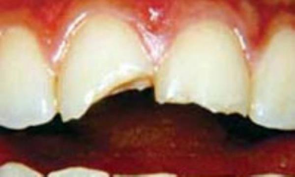 آسیب های دندانی